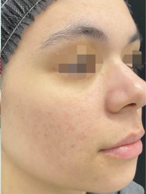 Laser Skin Resurfacing after at NUVIDA Aesthetics & Wellness in American Fork, UT