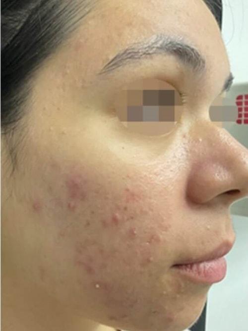 Laser Skin Resurfacing before at NUVIDA Aesthetics & Wellness in American Fork, UT