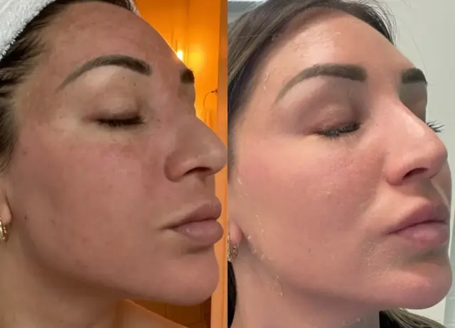 Microneedling result at Ageless Remedies SouthPark in Charlotte, NC