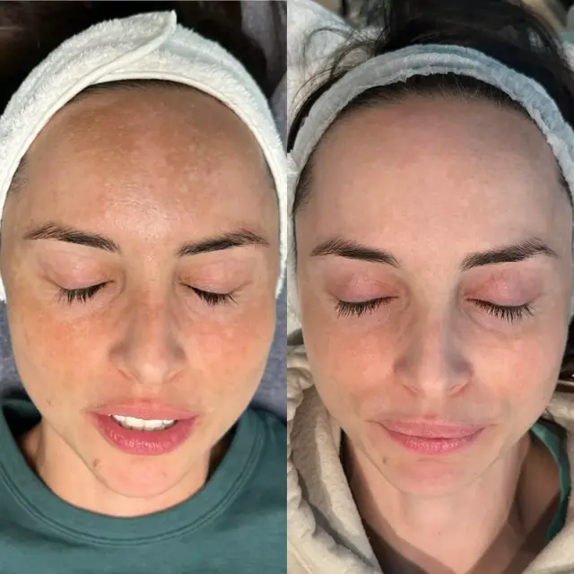 Laser Skin Resurfacing result at Ageless Remedies SouthPark in Charlotte, NC
