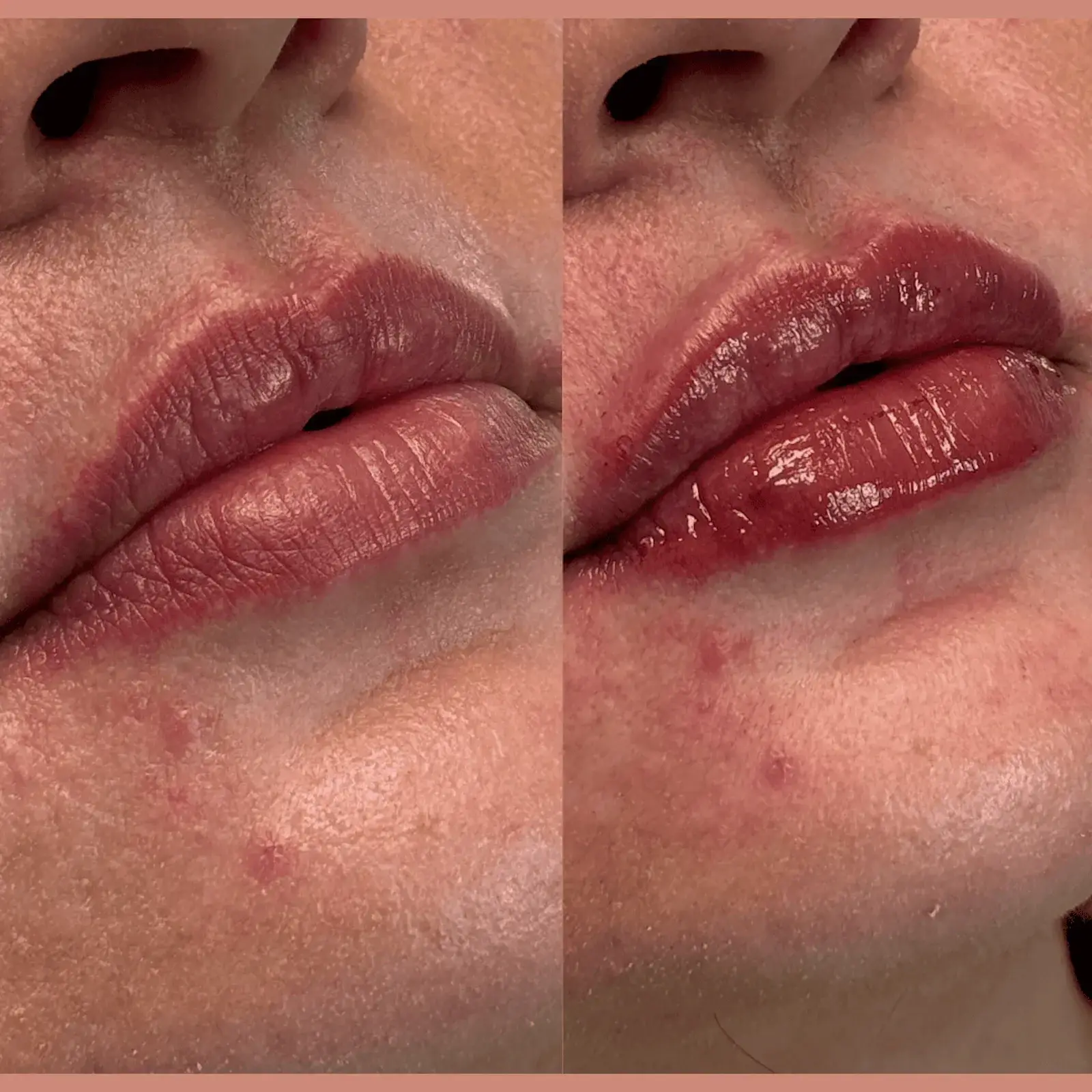 Ageless Remedies SouthPark lip filler result — Charlotte, NC