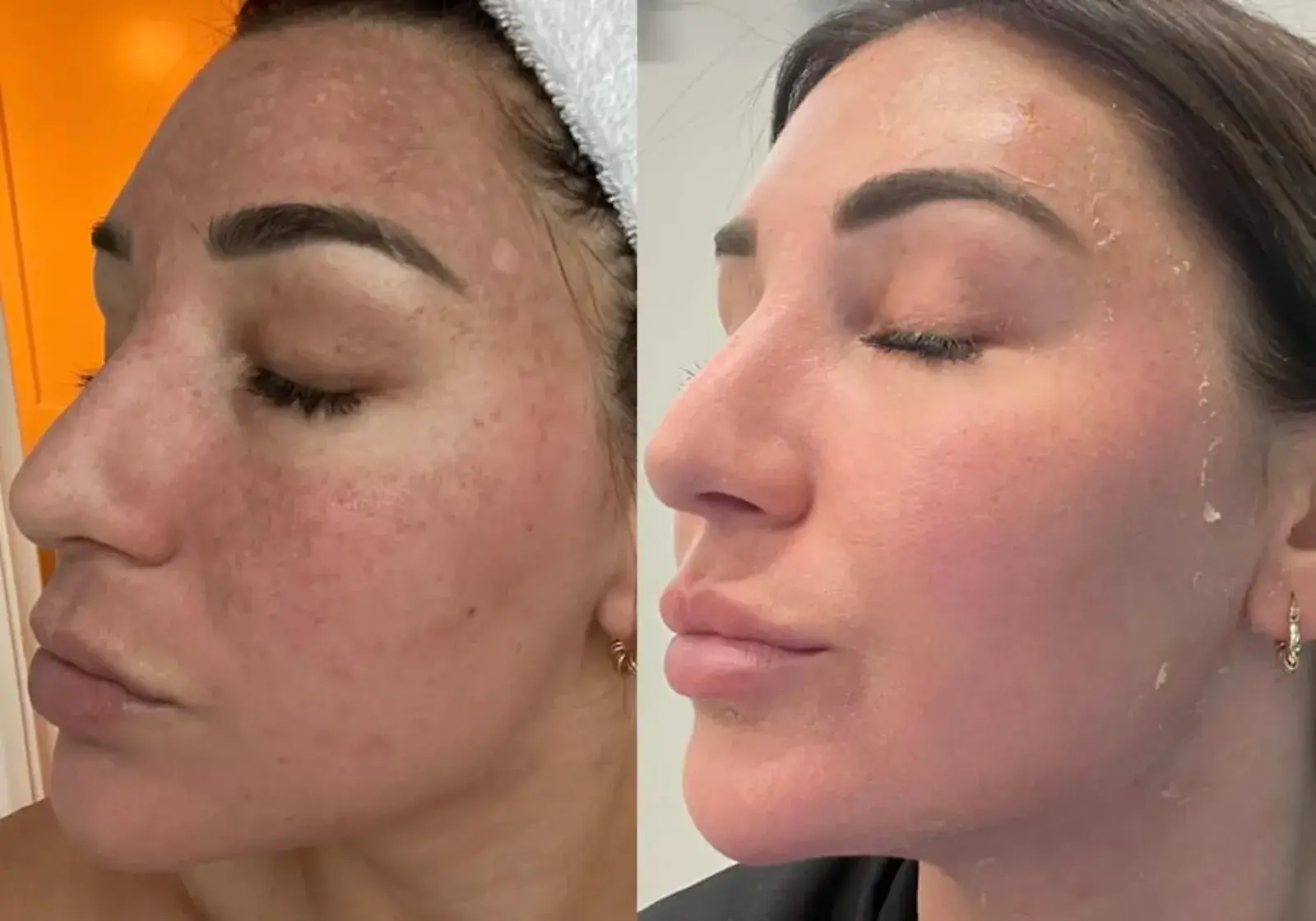 Ageless Remedies SouthPark chemical peel result — Charlotte, NC