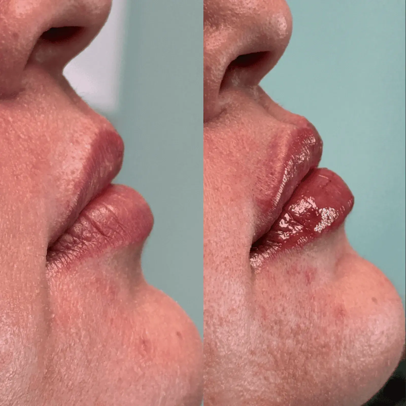 Ageless Remedies SouthPark lip filler result — Charlotte, NC