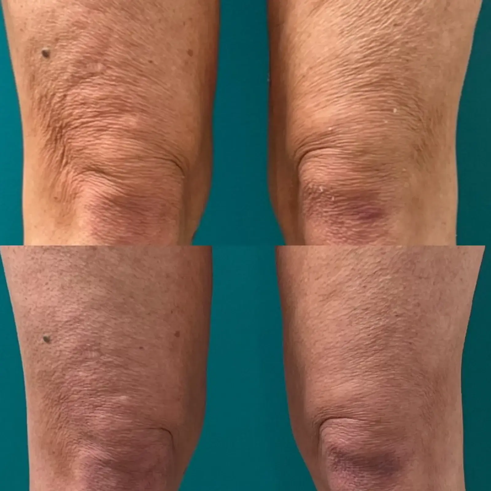 Ageless Remedies SouthPark skin tightening result — Charlotte, NC
