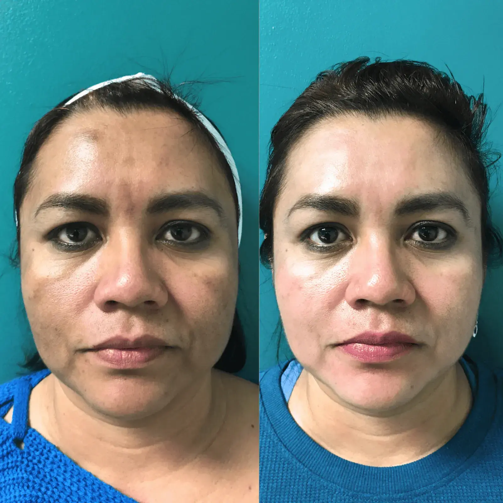Ageless Remedies SouthPark chemical peel result — Charlotte, NC