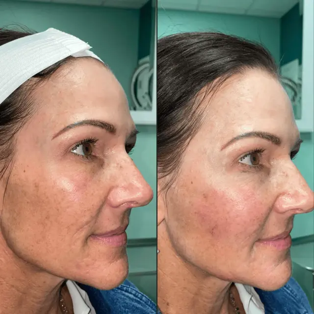 Dermal Fillers result at Ageless Remedies SouthPark in Charlotte, NC