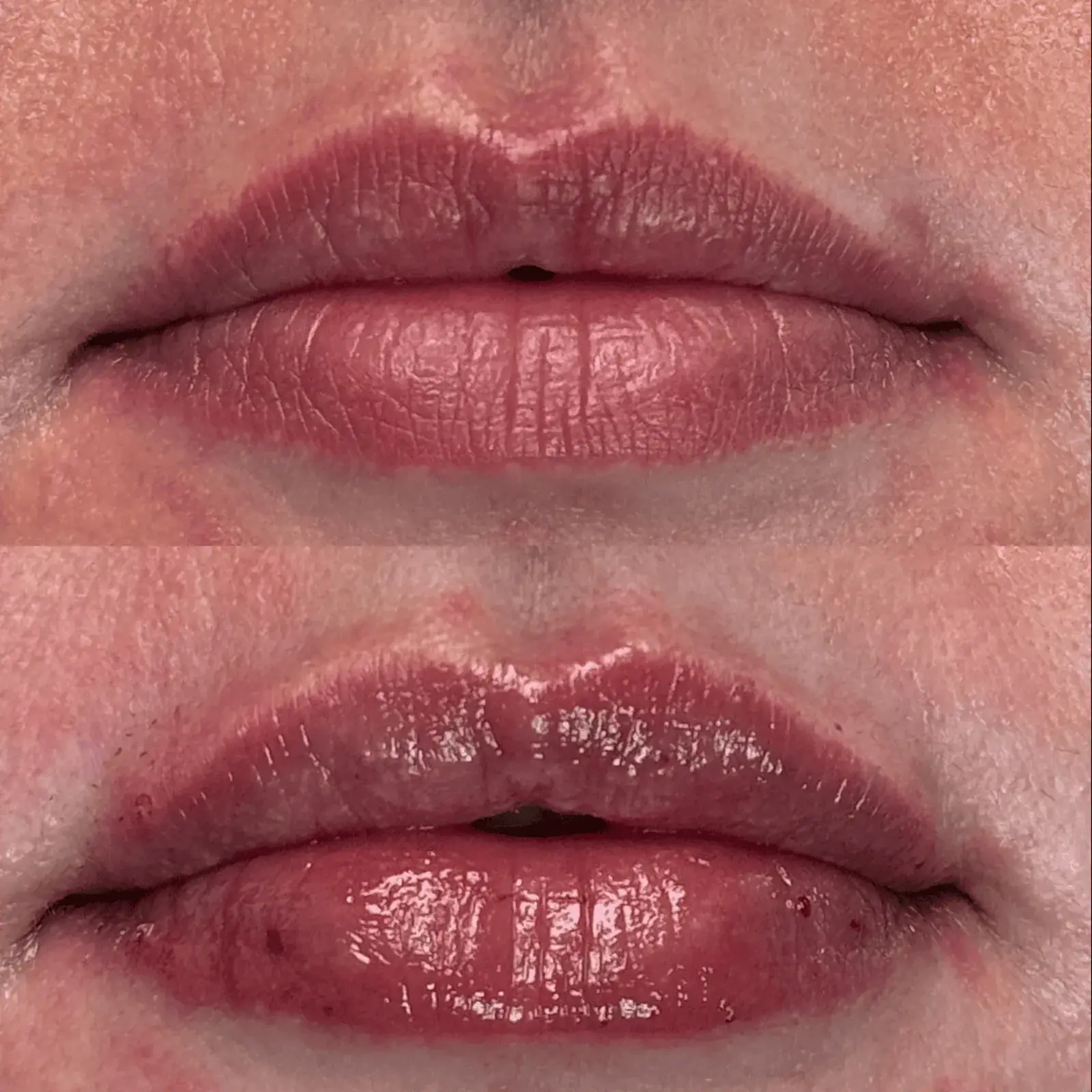Ageless Remedies SouthPark lip filler result — Charlotte, NC