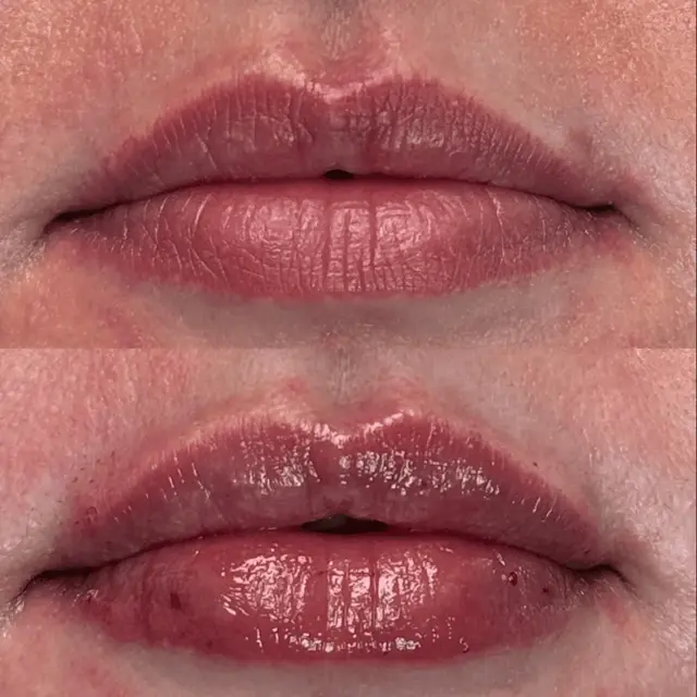 Lip Filler result at Ageless Remedies SouthPark in Charlotte, NC