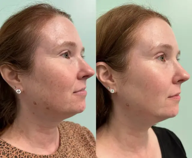 Laser Skin Resurfacing result at Ageless Remedies SouthPark in Charlotte, NC