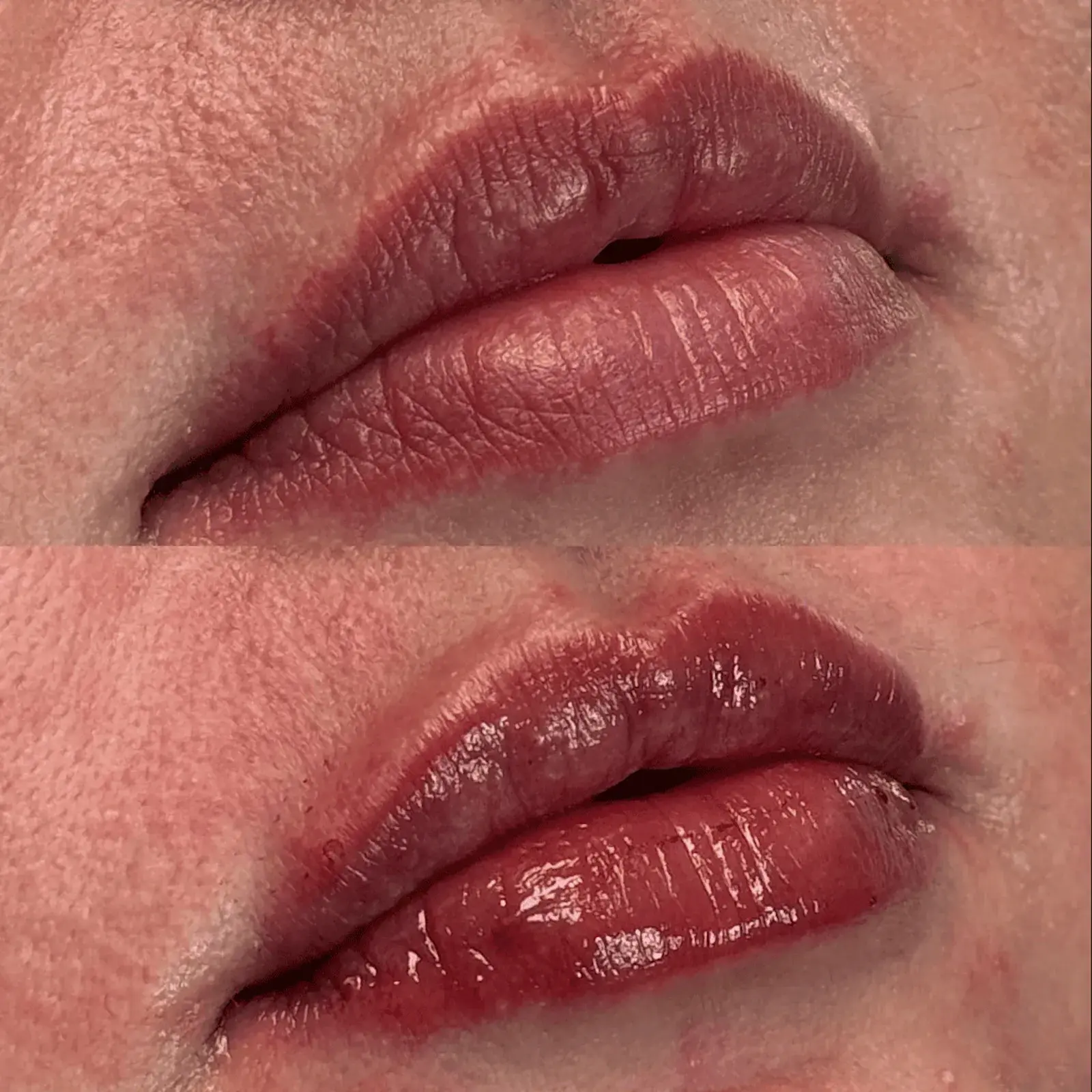 Ageless Remedies SouthPark lip filler result — Charlotte, NC
