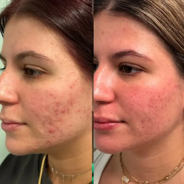 Laser Skin Resurfacing result at Ageless Remedies SouthPark in Charlotte, NC