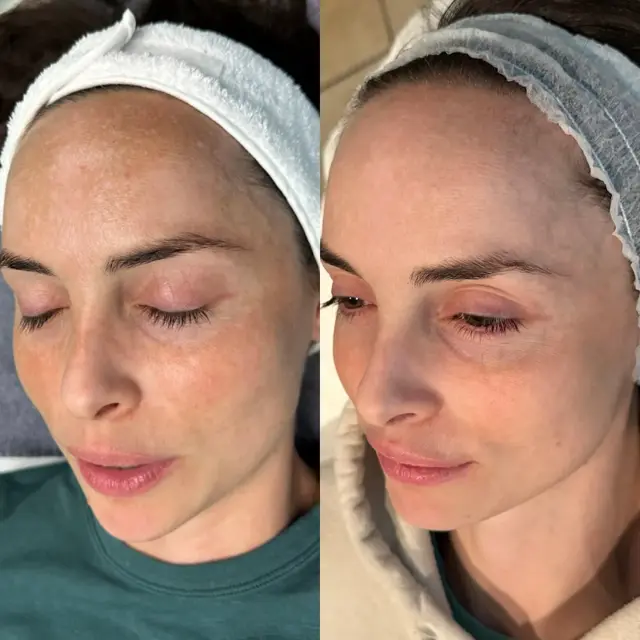 Laser Skin Resurfacing result at Ageless Remedies SouthPark in Charlotte, NC
