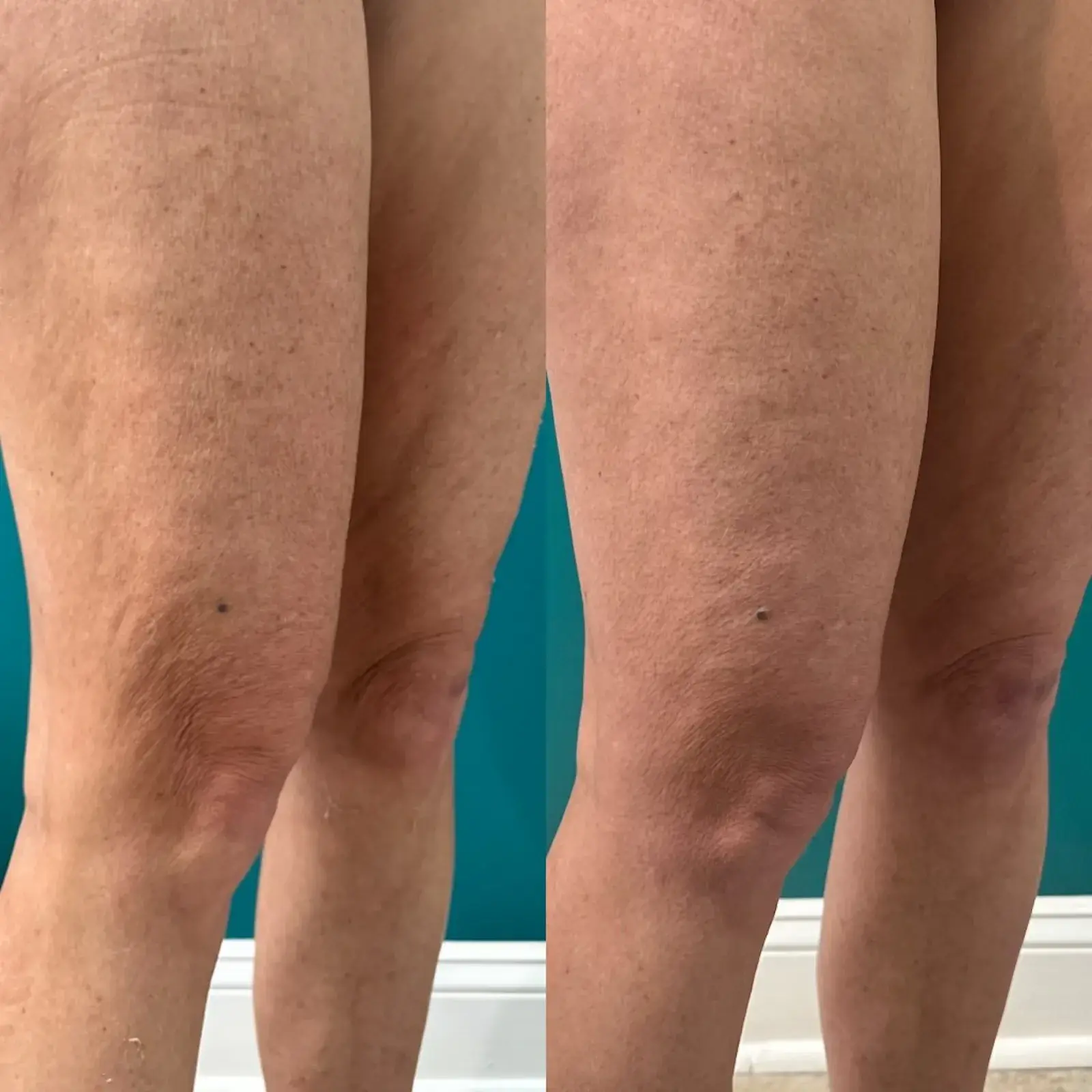 Ageless Remedies SouthPark skin tightening result — Charlotte, NC