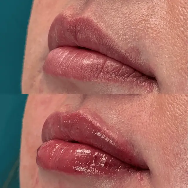 Lip Filler result at Ageless Remedies SouthPark in Charlotte, NC