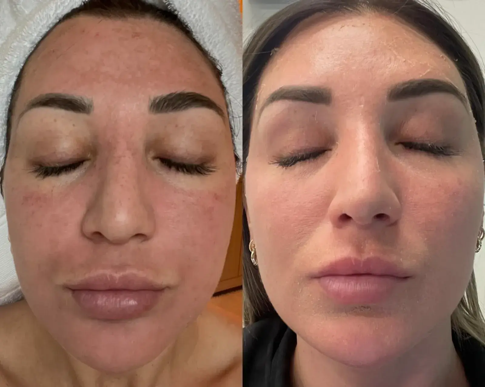Ageless Remedies SouthPark chemical peel result — Charlotte, NC