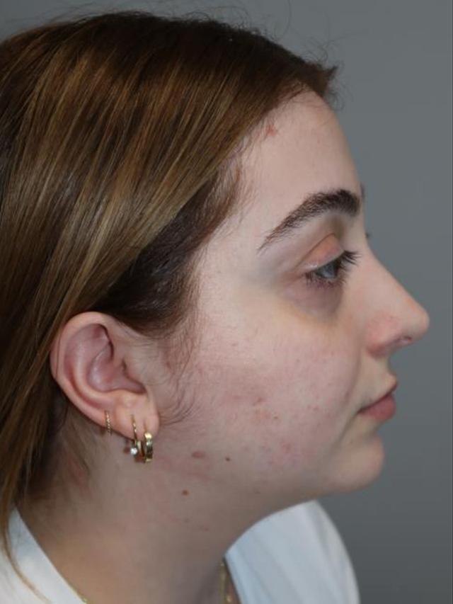 Rhinoplasty after at Sanjay Grover MD, FACS in Newport Beach, CA