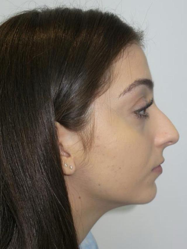 Rhinoplasty before at Sanjay Grover MD, FACS in Newport Beach, CA