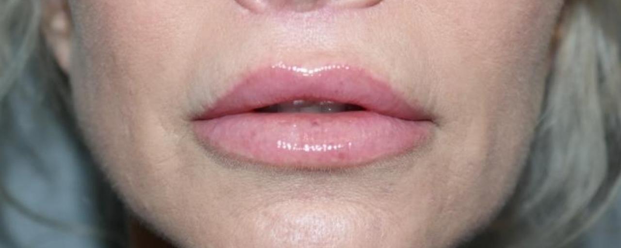 Sanjay Grover MD, FACS lip lift result — Newport Beach, CA