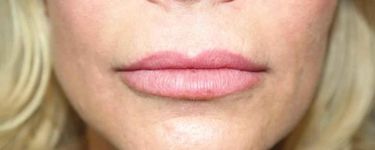Sanjay Grover MD, FACS lip lift result — Newport Beach, CA