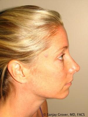 Rhinoplasty after at Sanjay Grover MD, FACS in Newport Beach, CA
