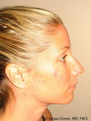 Rhinoplasty before at Sanjay Grover MD, FACS in Newport Beach, CA