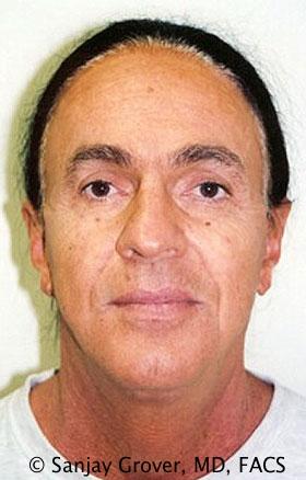 Sanjay Grover MD, FACS facelift after — Newport Beach, CA