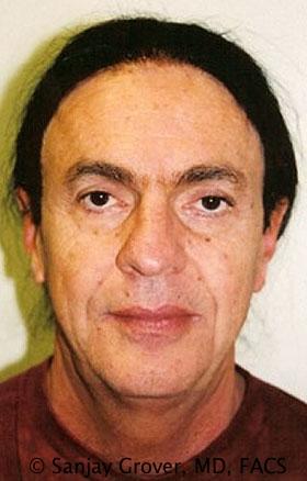Facelift before at Sanjay Grover MD, FACS in Newport Beach, CA