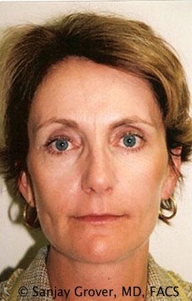 Sanjay Grover MD, FACS facelift after — Newport Beach, CA