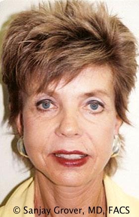 Sanjay Grover MD, FACS facelift after — Newport Beach, CA