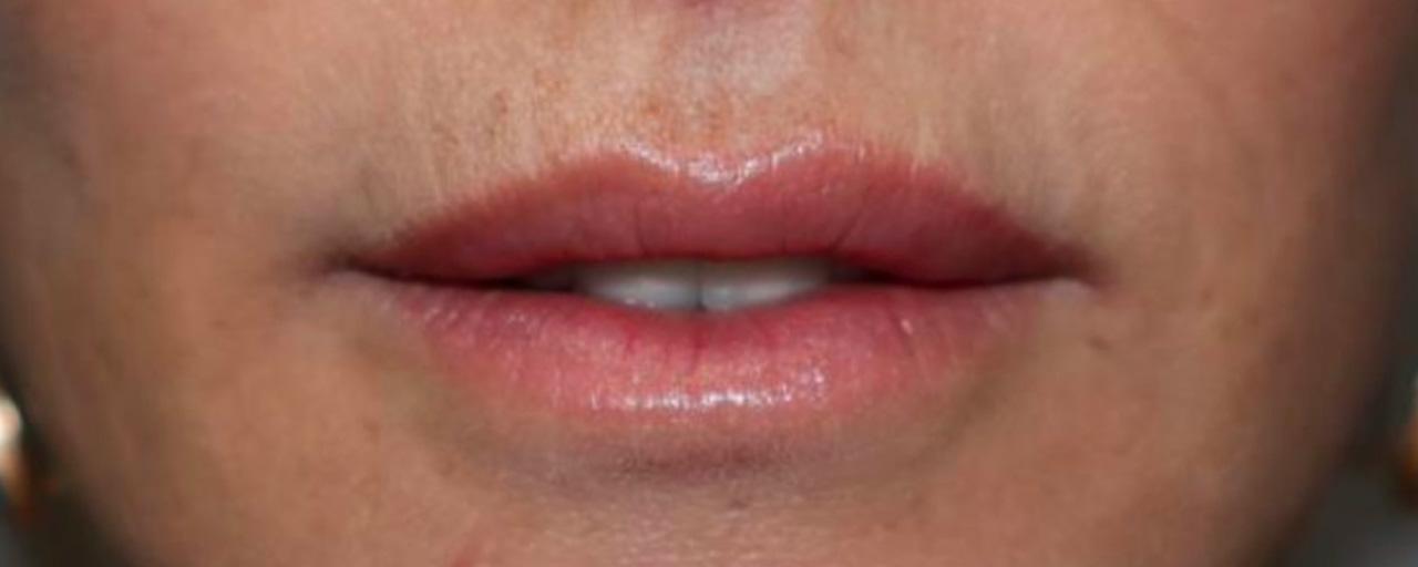 Sanjay Grover MD, FACS lip lift result — Newport Beach, CA