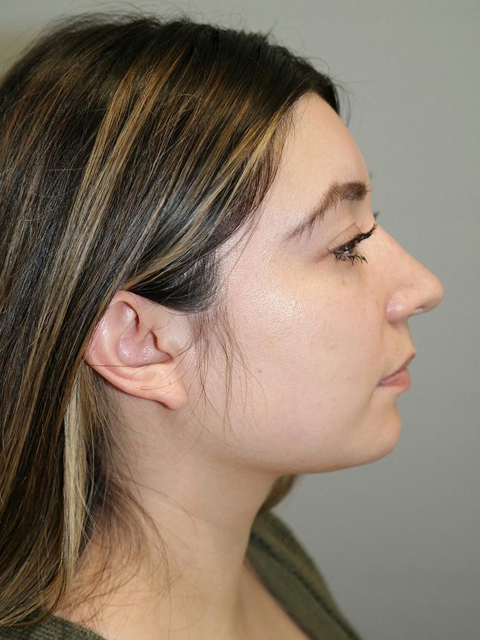 Sanjay Grover MD, FACS rhinoplasty after — Newport Beach, CA