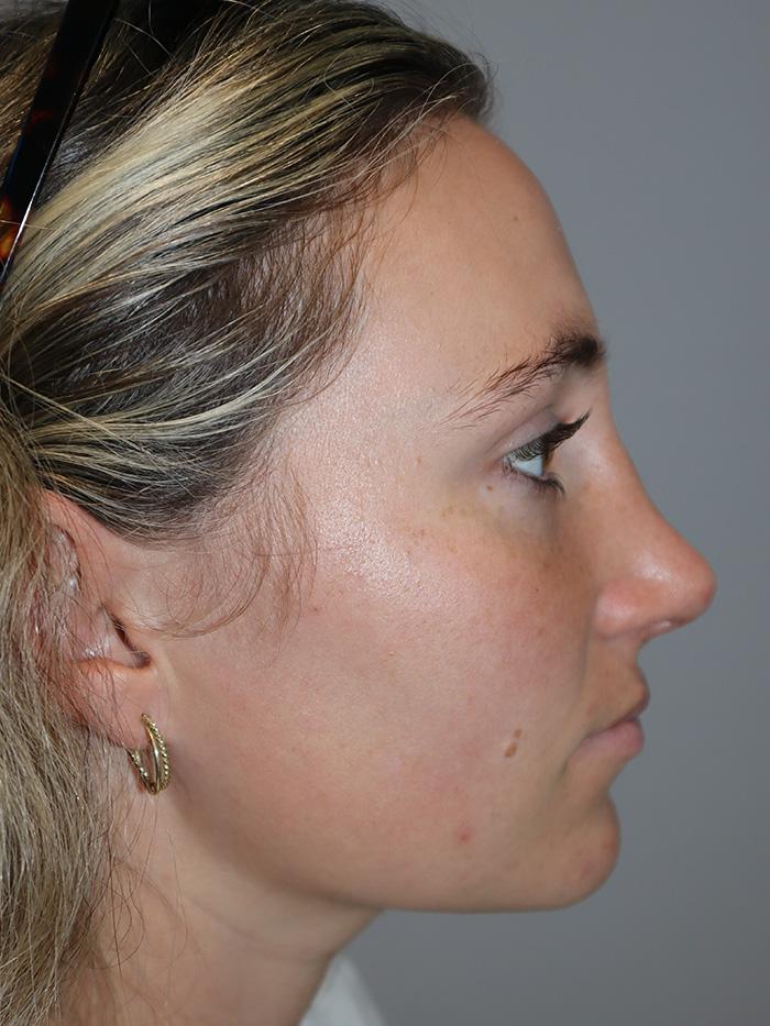 Sanjay Grover MD, FACS rhinoplasty after — Newport Beach, CA