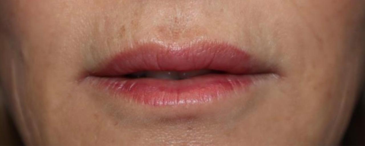 Sanjay Grover MD, FACS lip lift result — Newport Beach, CA