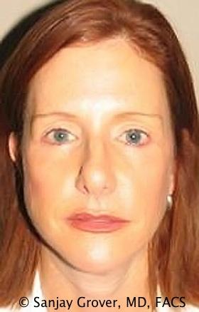 Sanjay Grover MD, FACS facelift after — Newport Beach, CA