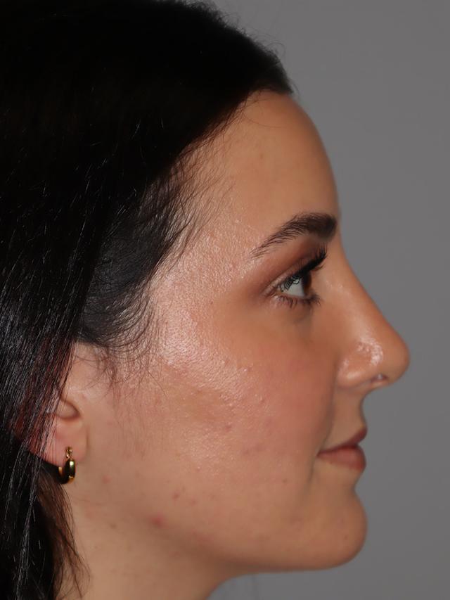 Rhinoplasty after at Sanjay Grover MD, FACS in Newport Beach, CA