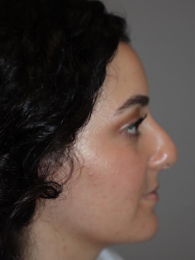 Rhinoplasty before at Sanjay Grover MD, FACS in Newport Beach, CA