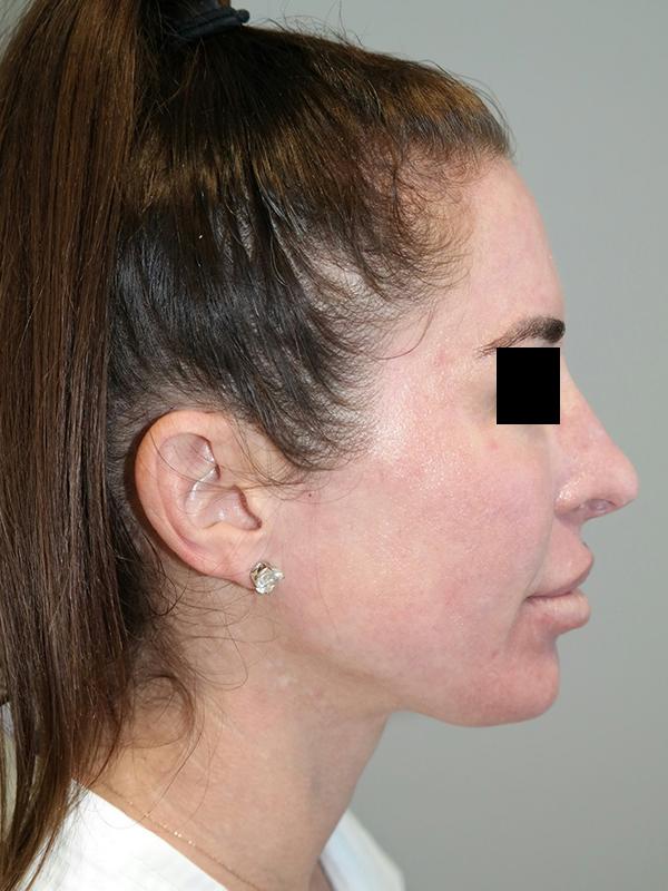Sanjay Grover MD, FACS rhinoplasty after — Newport Beach, CA