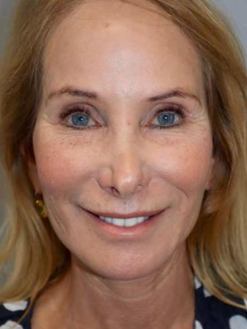 Sanjay Grover MD, FACS facelift after — Newport Beach, CA