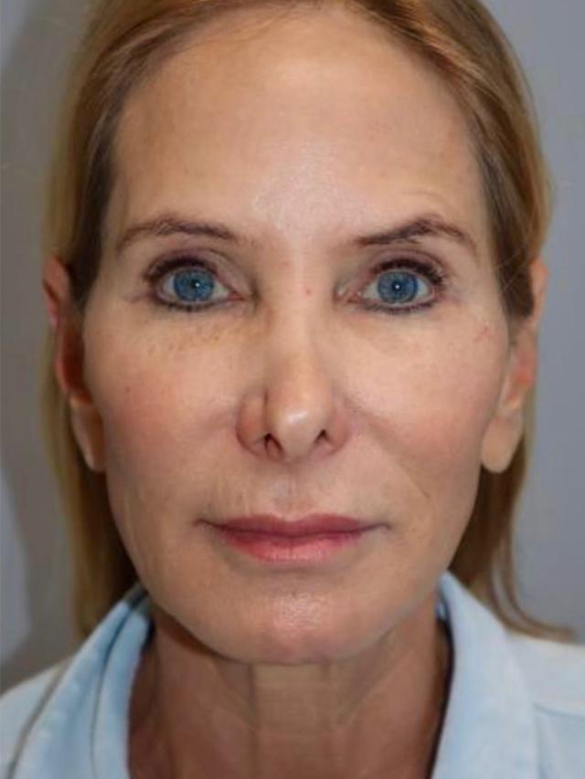 Facelift before at Sanjay Grover MD, FACS in Newport Beach, CA