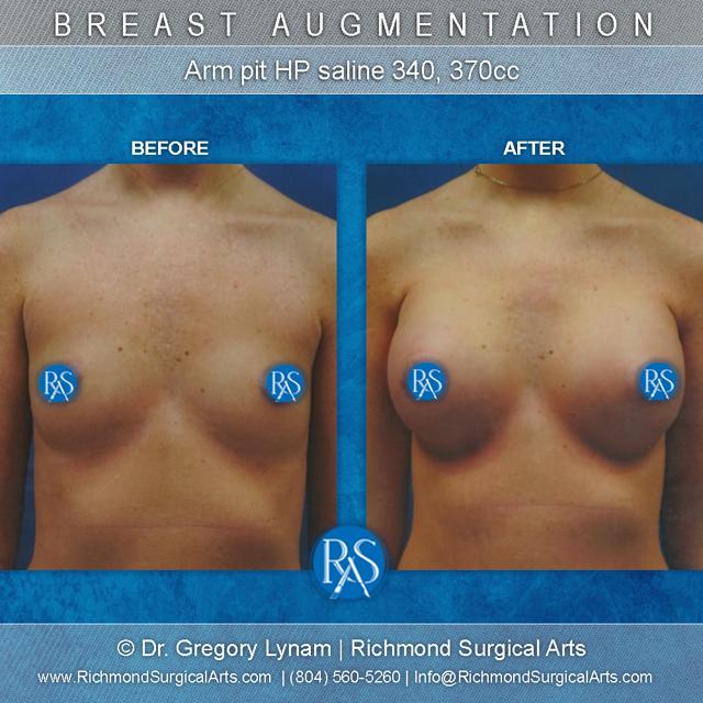 Breast Augmentation result at Richmond Surgical Arts in Richmond, VA