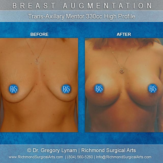 Breast Augmentation result at Richmond Surgical Arts in Richmond, VA
