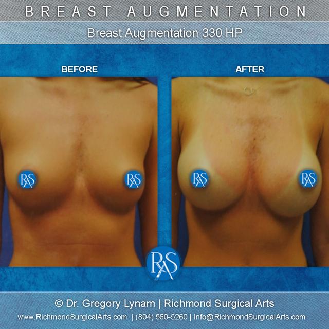 Breast Augmentation result at Richmond Surgical Arts in Richmond, VA