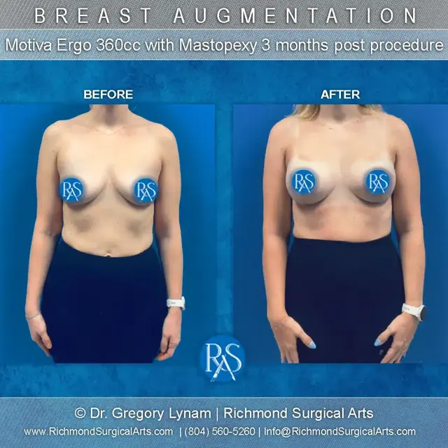 Breast Lift result at Richmond Surgical Arts in Richmond, VA