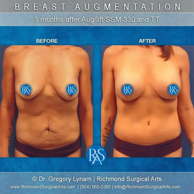 Mommy Makeover result at Richmond Surgical Arts in Richmond, VA