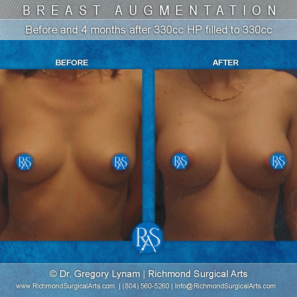 Richmond Surgical Arts breast augmentation result — Richmond, VA