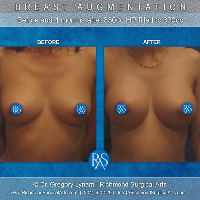 Breast Augmentation result at Richmond Surgical Arts in Richmond, VA