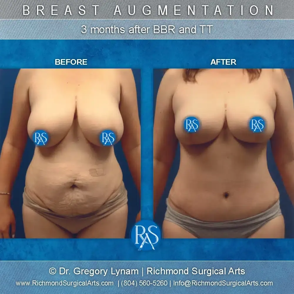 Richmond Surgical Arts mommy makeover result — Richmond, VA
