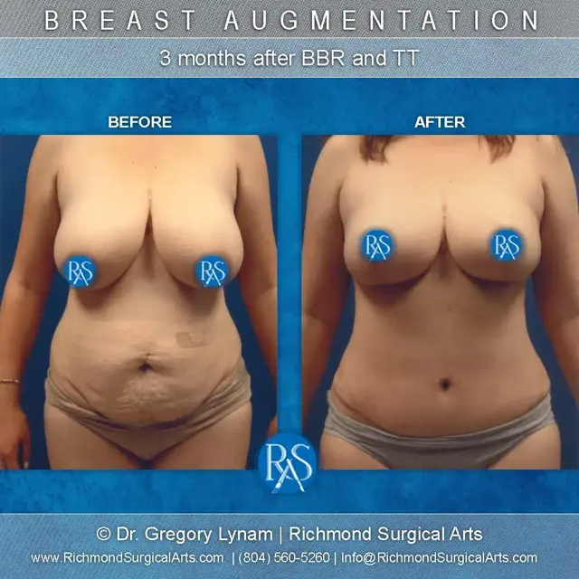 Mommy Makeover result at Richmond Surgical Arts in Richmond, VA