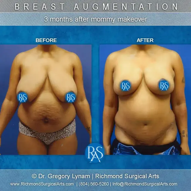 Mommy Makeover result at Richmond Surgical Arts in Richmond, VA