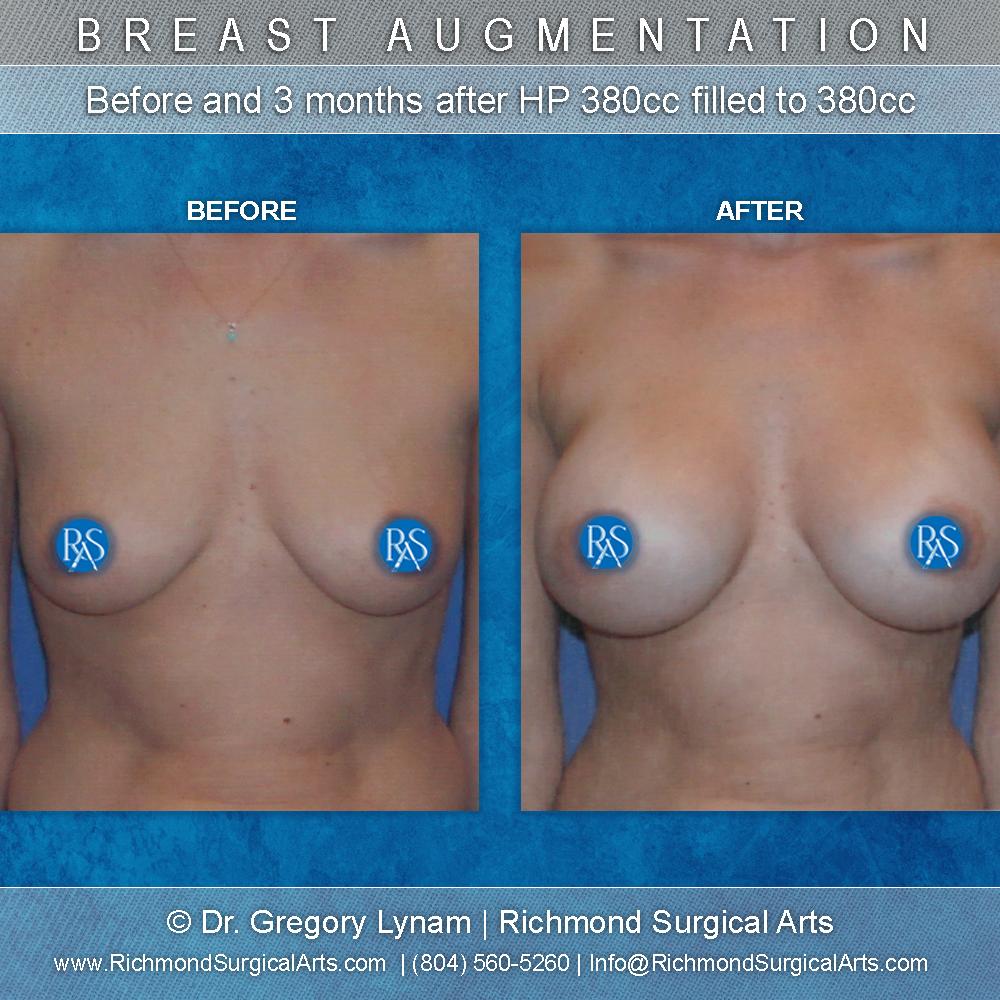 Richmond Surgical Arts breast augmentation result — Richmond, VA